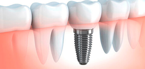 implantes-odontologicos-01